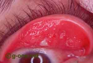 papiloma conjunctival gastric cancer with ascites