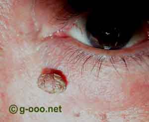 Verruga nas pálpebras: causas e o tratamento para o papiloma - SBCPO