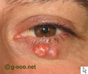 Pilomatrixoma