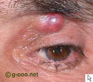 Pilomatrixoma