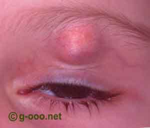 Tumor no olho - Entenda sobre tumores de pálpebra aqui!