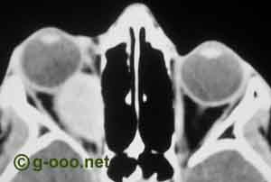 Rabdomiosarcoma