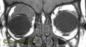 Rabdomiosarcoma