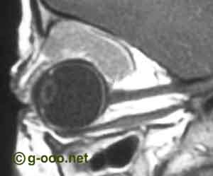 Rabdomiosarcoma